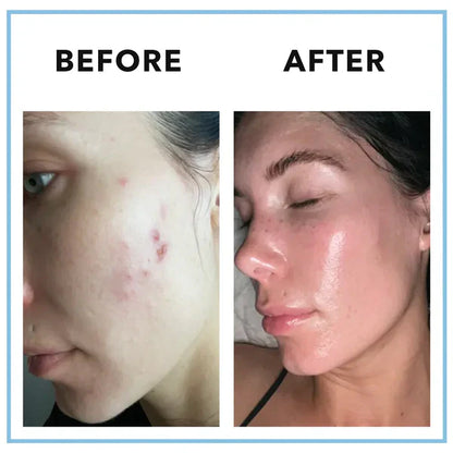CLEARSTEM MINDBODYSKIN™ Vitamin Supplement – Hormonal Acne & Skin Balance Formula – 90 Capsules